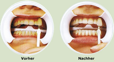 Foto: Vor einer Zahnaufhellung - Nach einer Zahnaufhellung